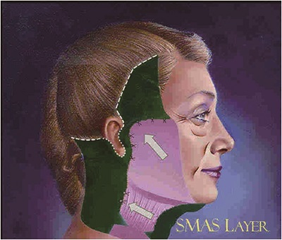 smas_treat_sm