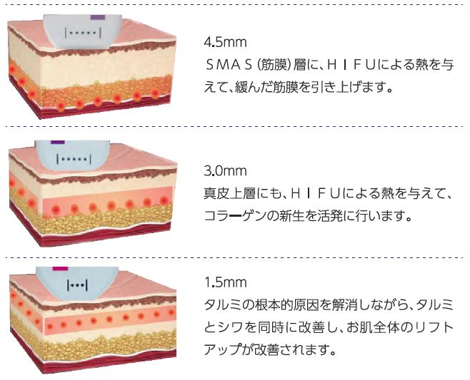 Hifu 最先端たるみ治療 ひろい内科クリニック